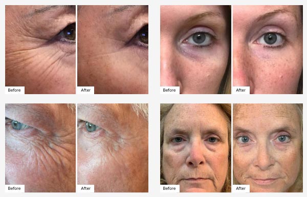 Before and After Real Result images of people that have used the All Eyes on You Set.
